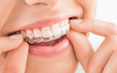 Invisalign : La révolution pour un sourire parfait